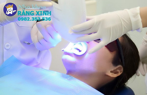 Tẩy trắng răng Laser Whitening 