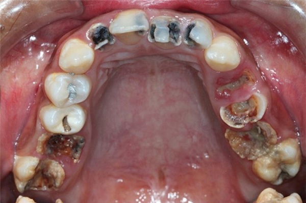 chữa đau nhức sâu răng hàm