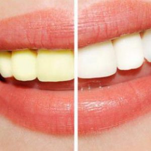 Tẩy trắng răng nhanh tại vinh