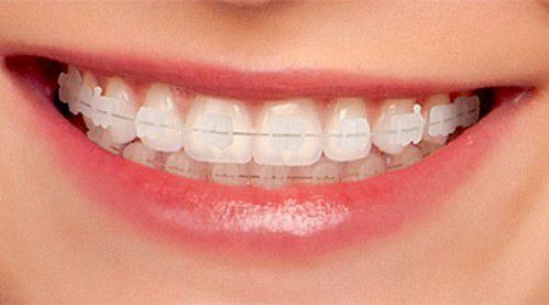 Niềng răng nên sử dụng loại mắc cài nào là tốt nhất