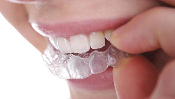 Hiệu quả của niềng răng không mắc cài Invisalign