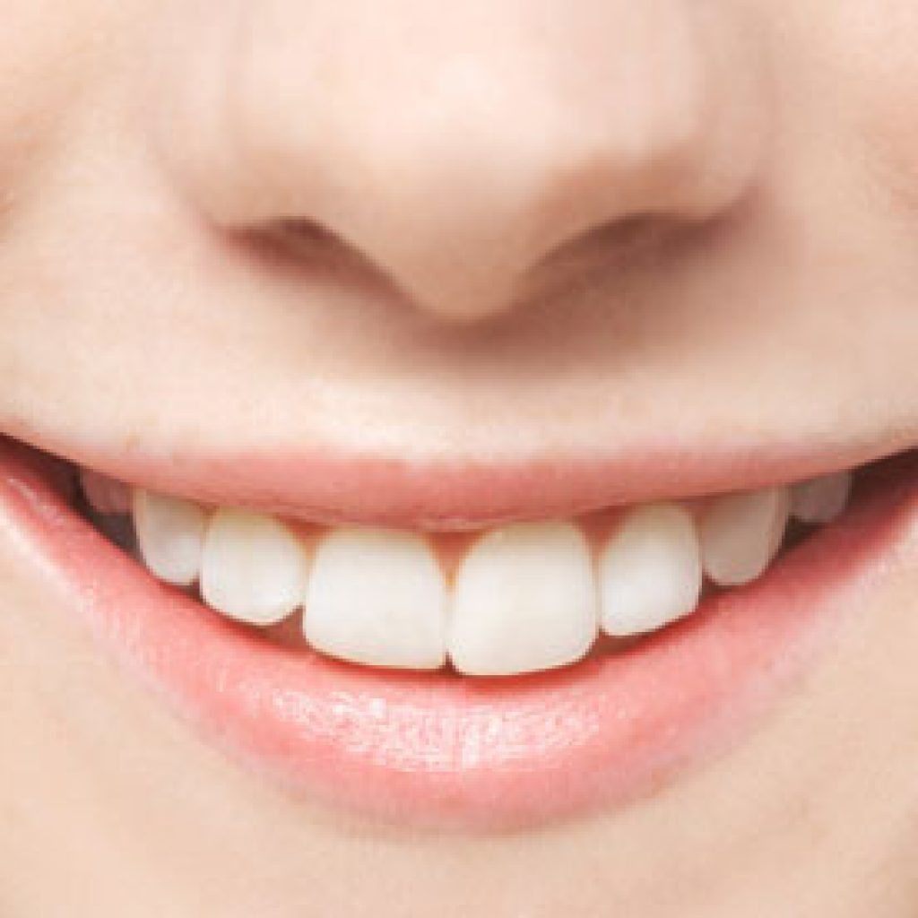 Hiệu quả của niềng răng không mắc cài Invisalign