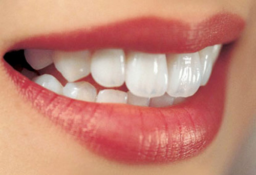 Răng sứ có nên tẩy trắng không