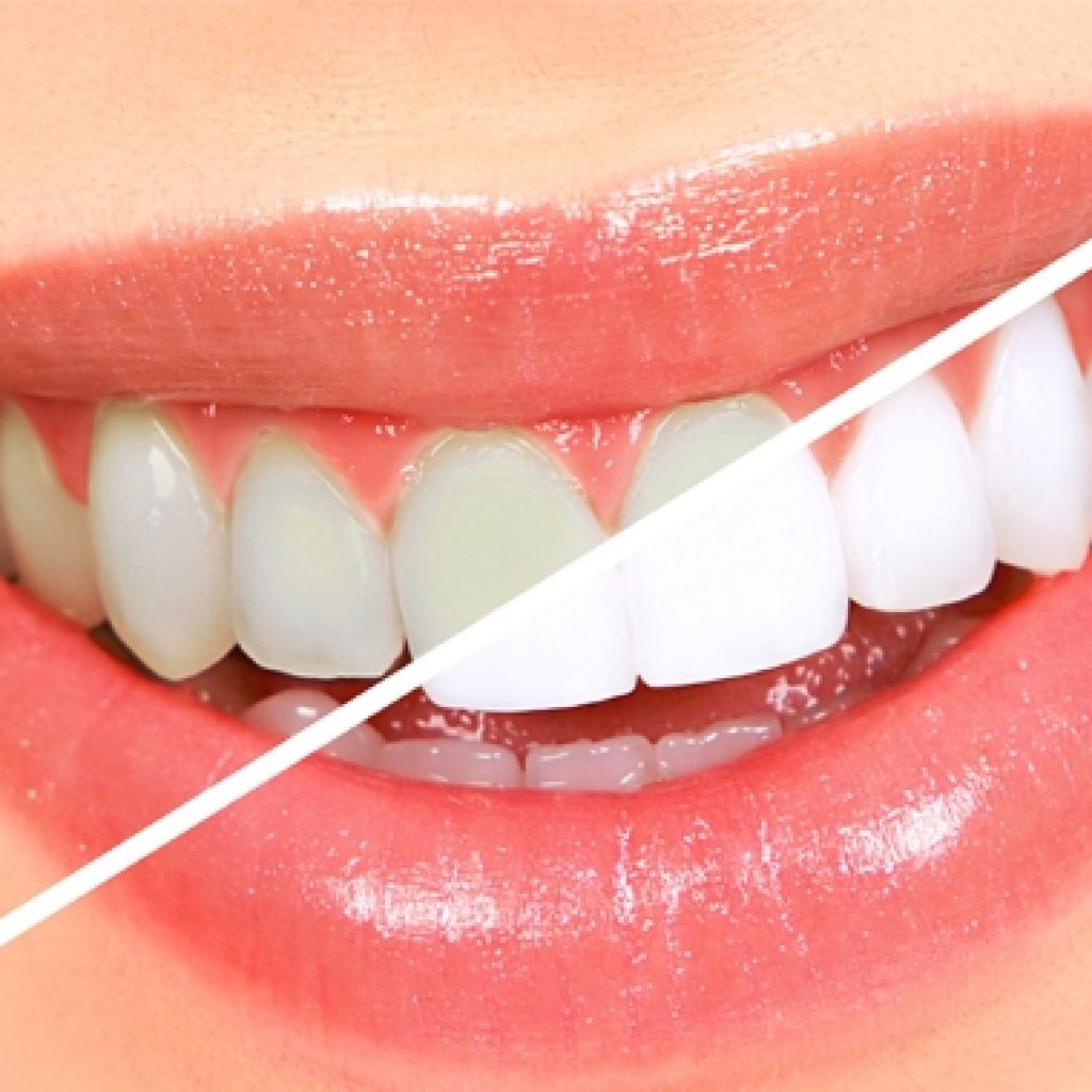 5 cách tẩy trắng răng an toàn tại nhà hiệu quả cao