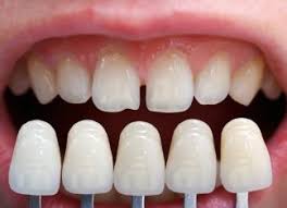 Bọc răng sứ sử dụng được bao lâu