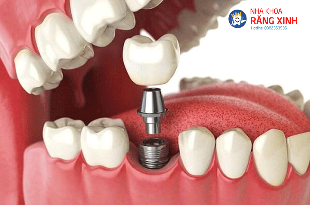 Bật mí những lí do bạn nên trồng răng implant