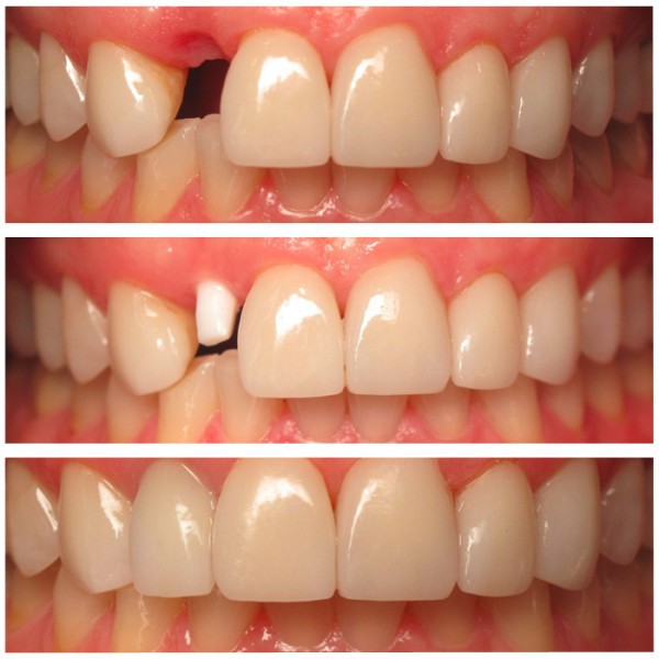 Cắm - Ghép Implant: Giải pháp tối ưu để phục hồi những răng đã mất