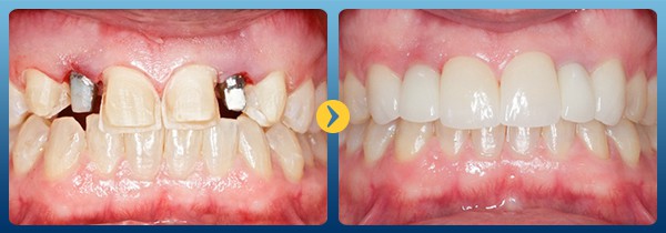 Cắm - Ghép Implant: Giải pháp tối ưu để phục hồi những răng đã mất
