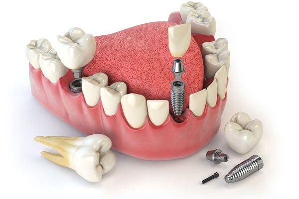 Thời gian thực hiện quy trình trồng răng Implant thế nào? Răng Implant sử dụng được bao lâu?